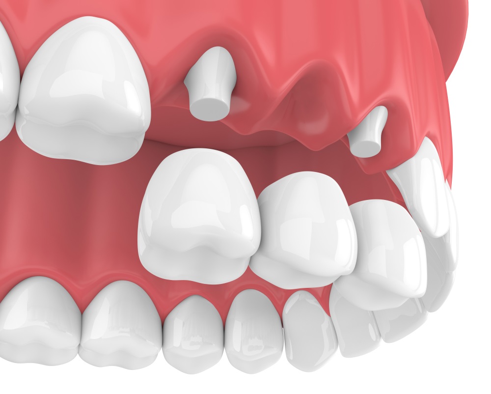 Quy trình bọc răng sứ - Bước 3